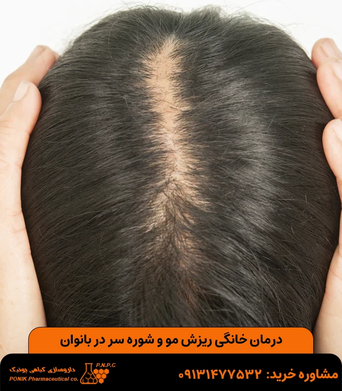 درمان خانگی ریزش مو و شوره سر در بانوان